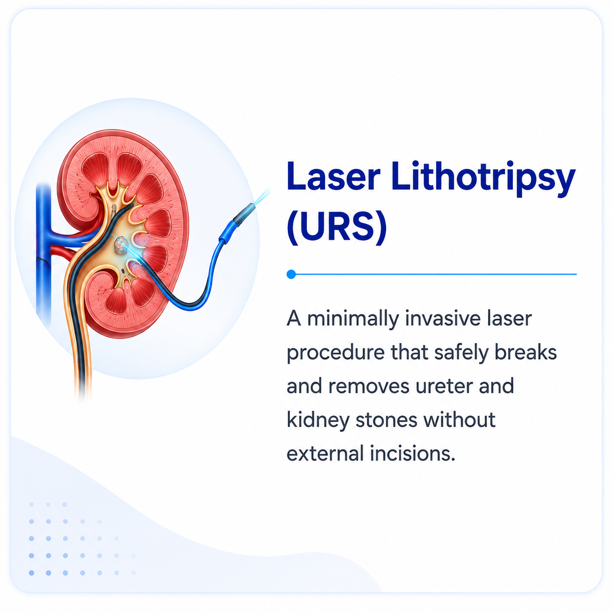 Medical illustration of RIRS (Retrograde Intrarenal Surgery) showing flexible laser treatment for kidney stones without external incisions.