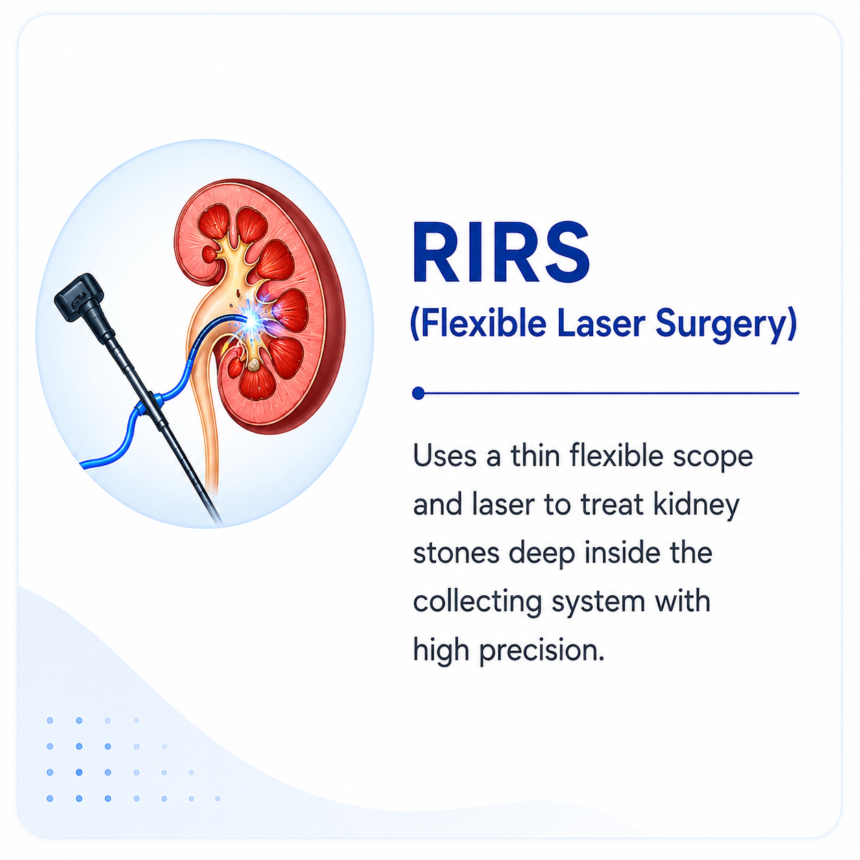 Medical illustration of Laser Lithotripsy (URS) showing a minimally invasive laser procedure to treat kidney and ureter stones without external incisions.