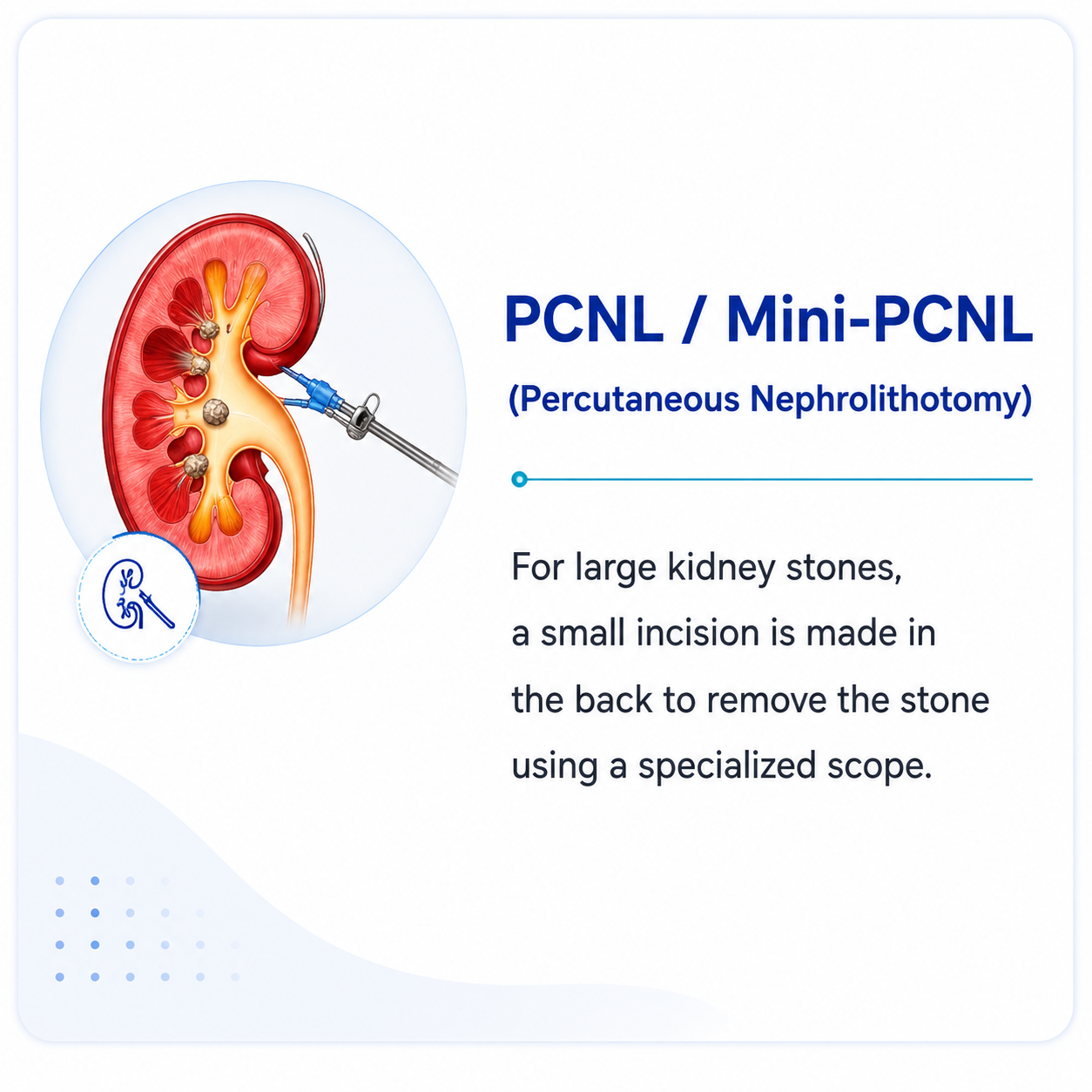 Medical illustration of ESWL (Extracorporeal Shock Wave Lithotripsy) showing non-invasive shock wave treatment for kidney and upper ureter stones.
