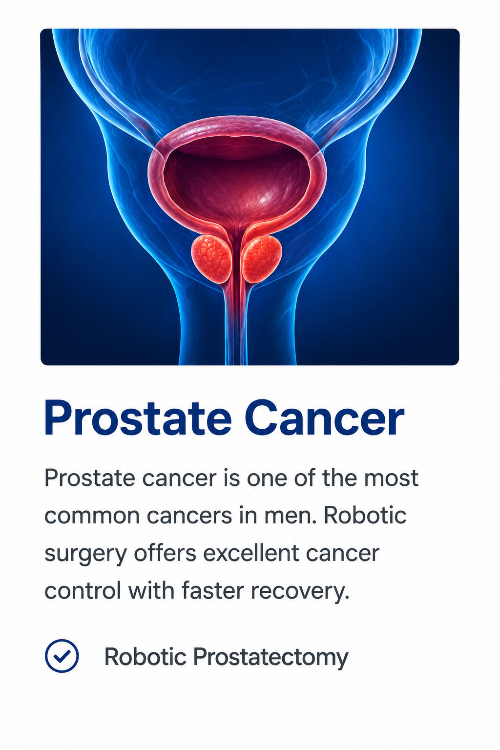 Illustration of prostate cancer showing the prostate gland and urinary bladder with advanced robotic prostatectomy treatment by Dr. Ram Prasad in Hyderabad.