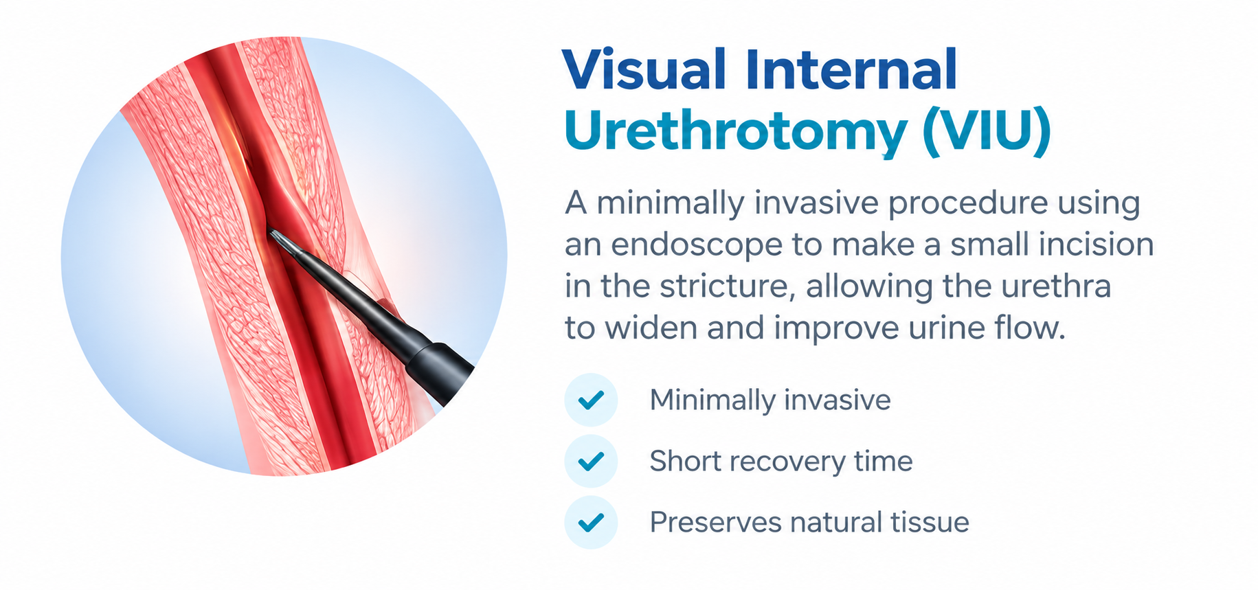 Visual Internal Urethrotomy (VIU) procedure for urethral stricture treatment by Dr. Ram Prasad